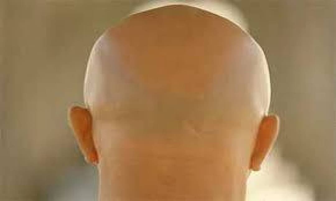 الصلعان لن يحولوا أشعة الشمس لطاقة