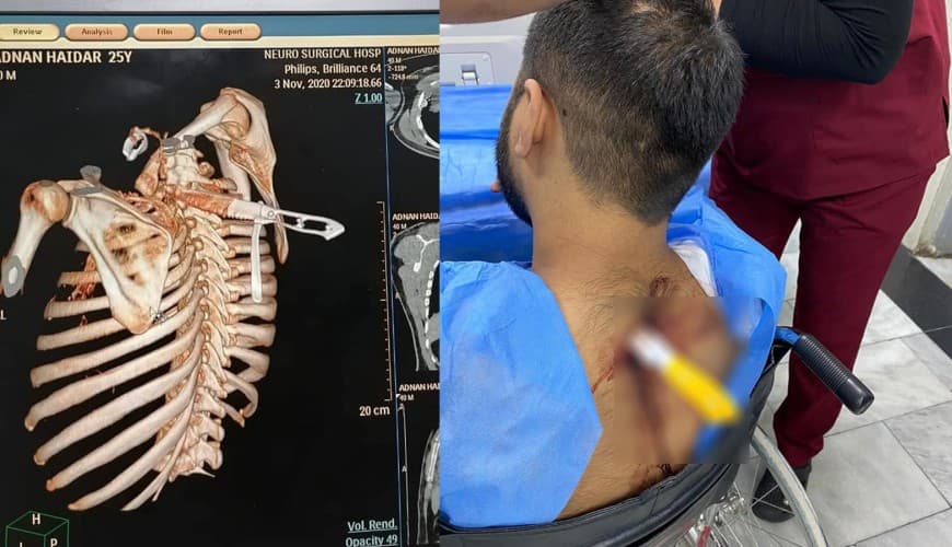 هذا الرجل تعرض للطعن في شجار ببغداد ولم تطعنه زوجته في منبج