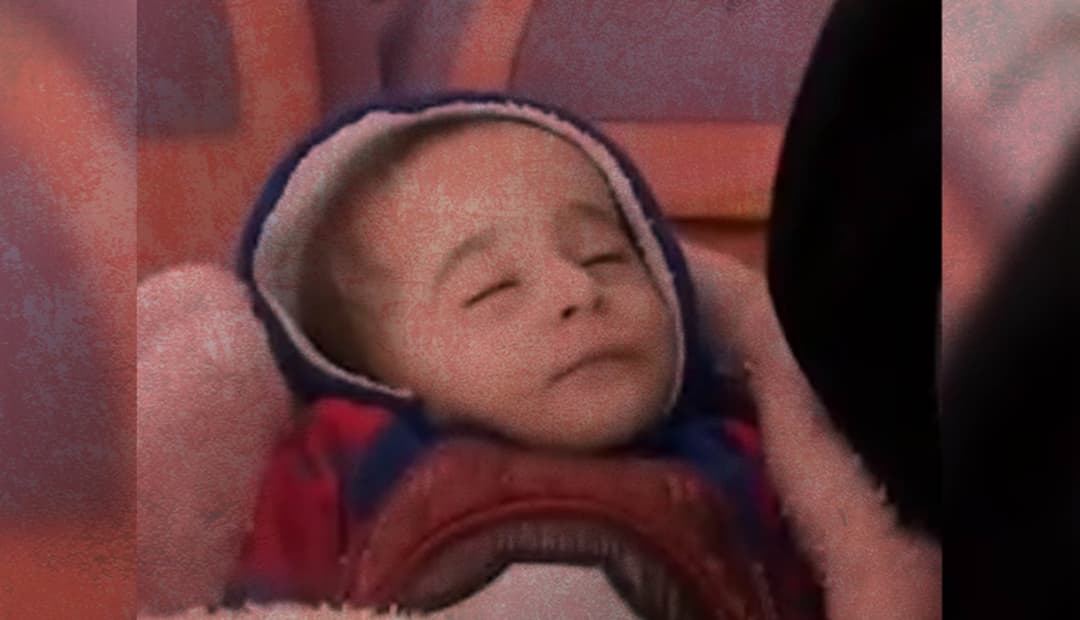 هذه الطفلة فقدت حياتها نتيجة شلل دماغي وليس نتيجة الجوع