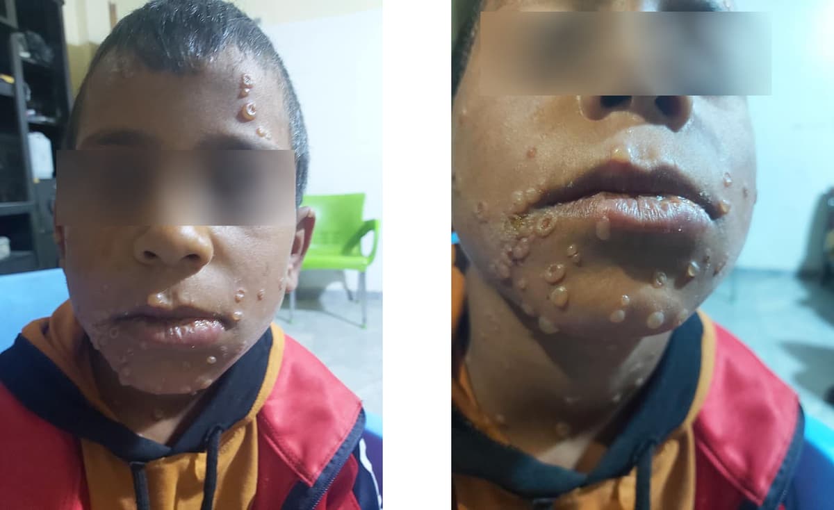 Image accompanying تسجيل أول حالة جدري القرود في سوريا