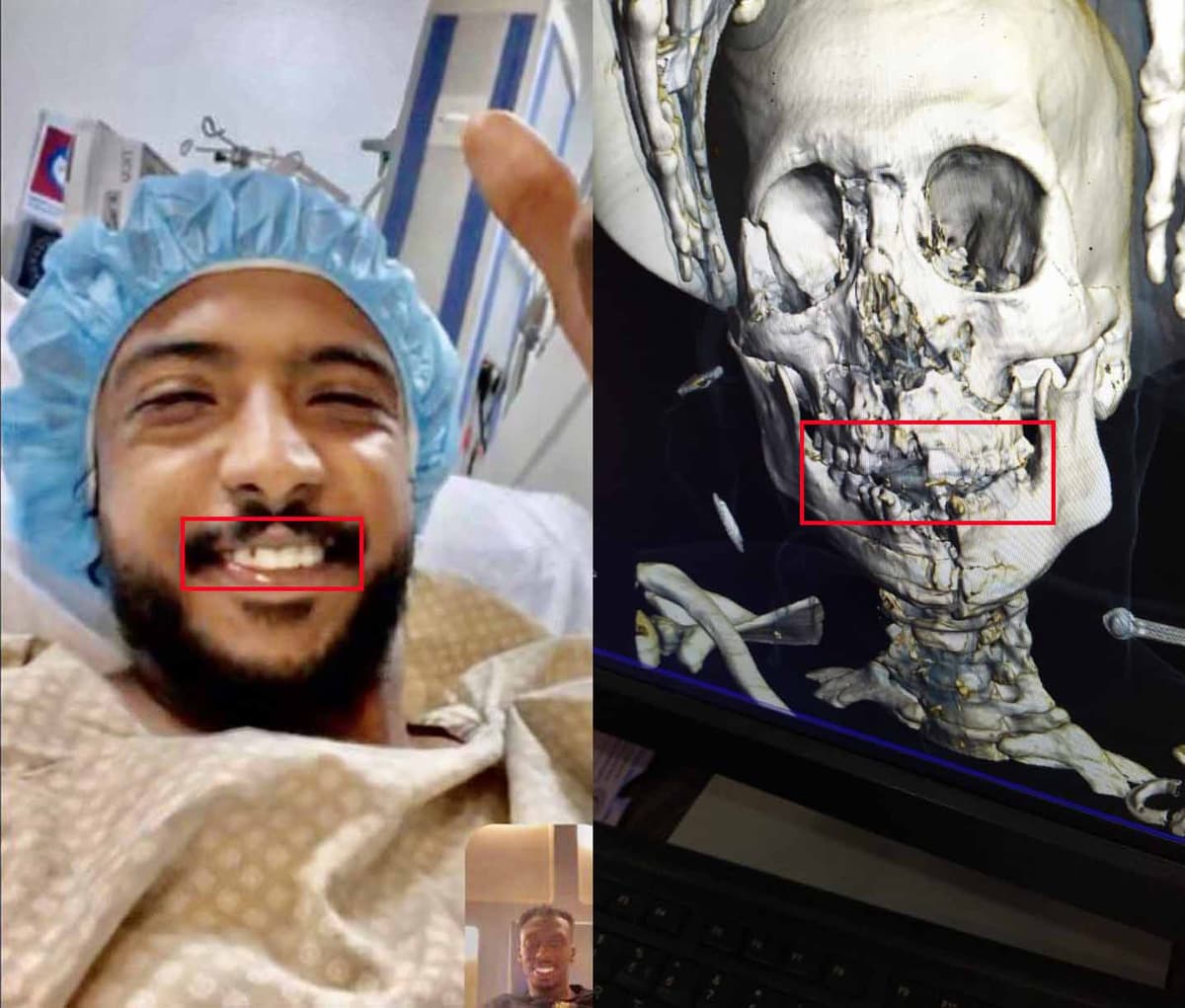 Image accompanying صور شعاعية ل "ياسر الشهراني" بعد تعرضه لكسر في الفك و عظام الوجه مع حاجته لتدخل جراحي سريع بسبب النزيف الداخلي